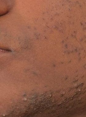 Ingrown hairs
