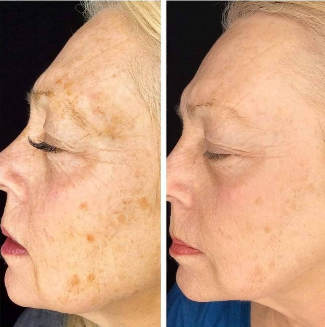 Laser pigmentation treatment