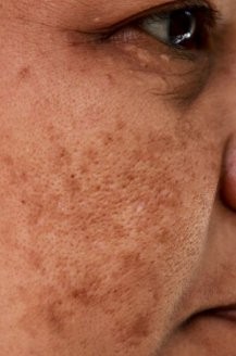 Sun damage and age spots — laser pigmentation treatment