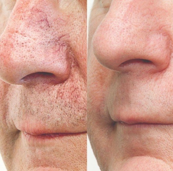 Laser redness & vessel treatment — broken capillaries and redness, before and after