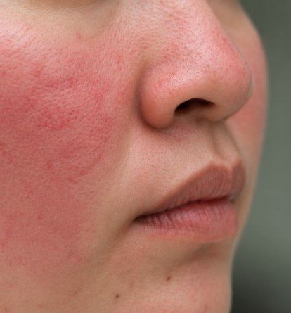 Laser treatment for redness & vessels