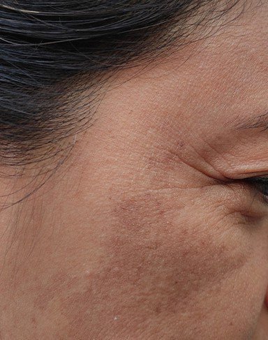 Laser skin rejuvenation