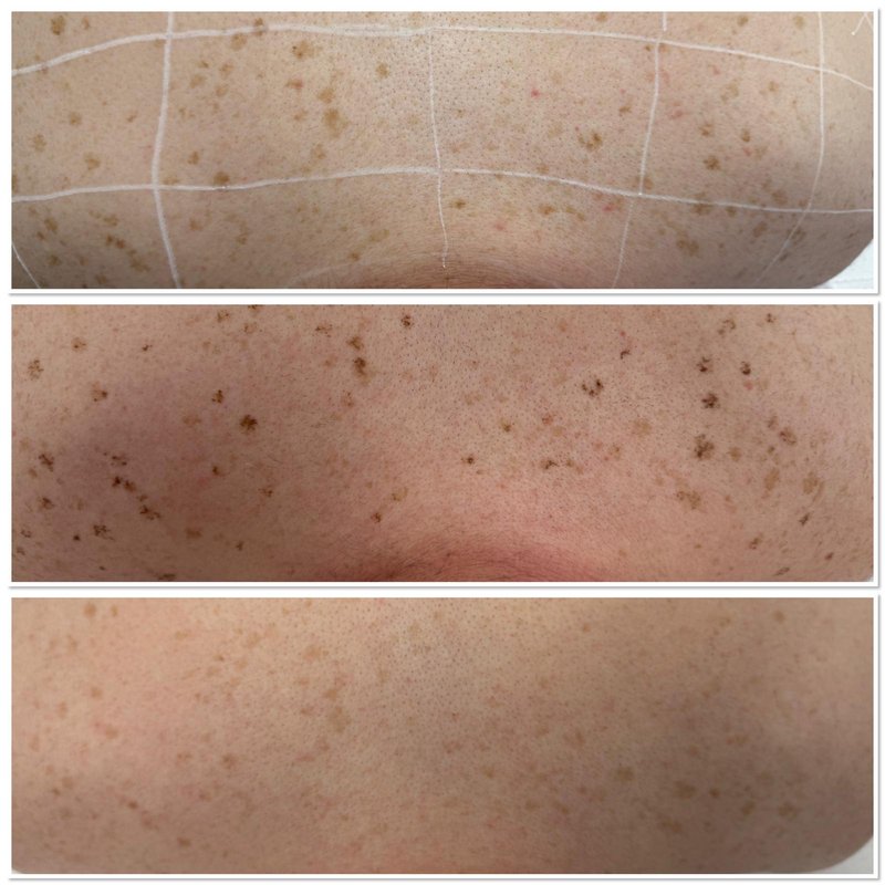 Laser pigmentation on the chest — before, immediately after and one month after