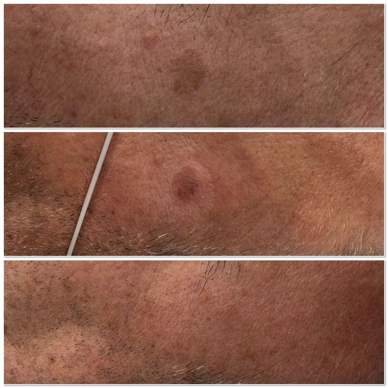 Laser pigmentation treatment — before, immediately after and one month after